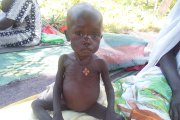 Akolde leidet neben Mangelernährung auch an Malaria. Das Mädchen benötigt nun eine spezielle Ernährung und passende Medikamente. Mit Ihrer Unterstützung können Kinder wie Akolde behandelt werden.